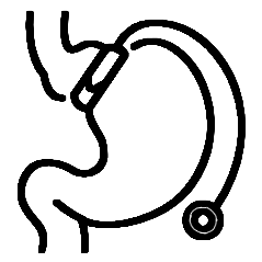 balon-intragastrico